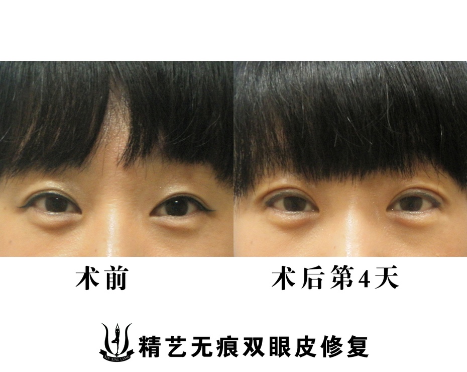双眼皮失败了吗_医网专家问答|mdash;双眼皮修