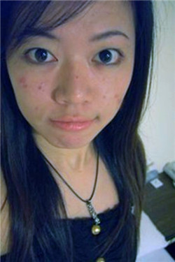 额头长痘痘怎么消除-经典重庆新闻中心-经典重