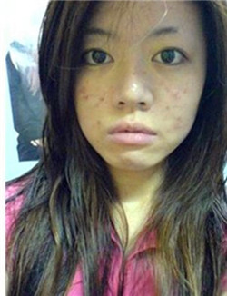 下巴长痘痘怎么消除-经典重庆新闻中心-经典重