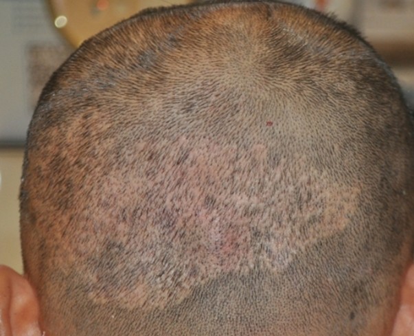 我在科发源做二次植发失败修复