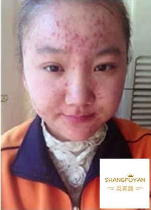 去痘印小窍门 - 云同盟·生活频道