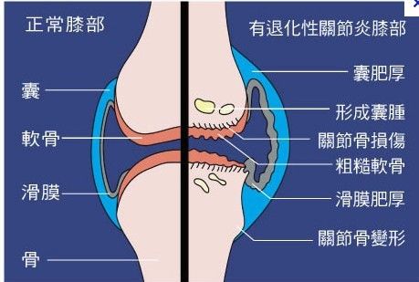 退化性关节炎——软固关