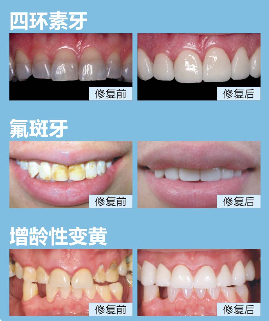 四环素牙,氟斑牙,增龄性变黄等牙齿属于内源性变色,美白牙膏