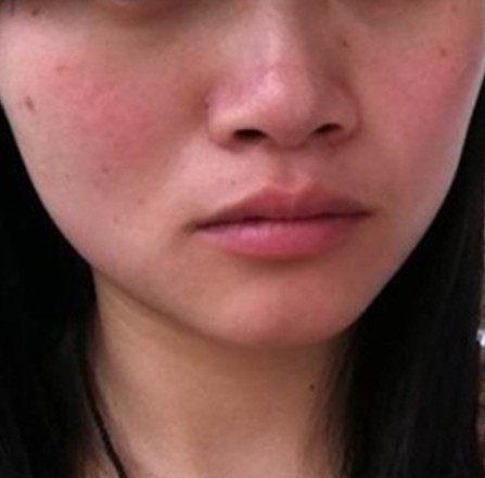 脸部皮肤过敏症状,告别隐痛,不怕人事部再冤枉