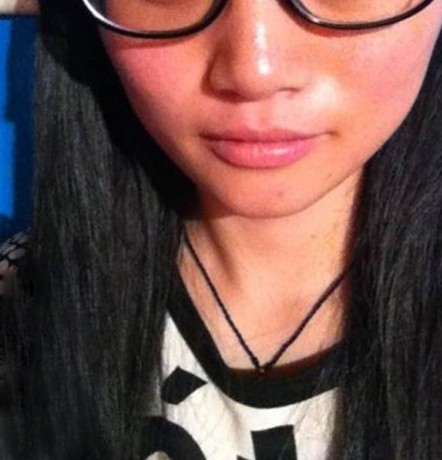 脸部皮肤过敏症状,告别隐痛,不怕人事部再冤枉