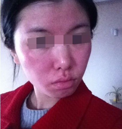 皮肤过敏用什么药,张郩斌心存感激,不一样的方