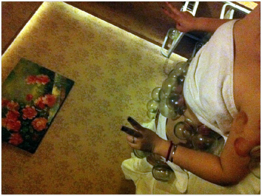 拔罐减肥的心酸之路_第1页_减肥瘦身帮帮团