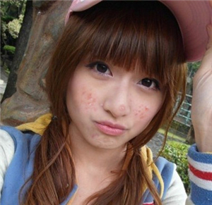 长痘痘不能吃什么 - 云同盟·生活频道