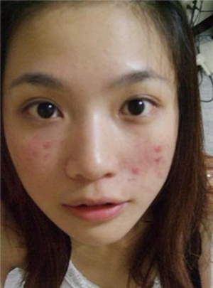 人中旁边长痘痘怎么办