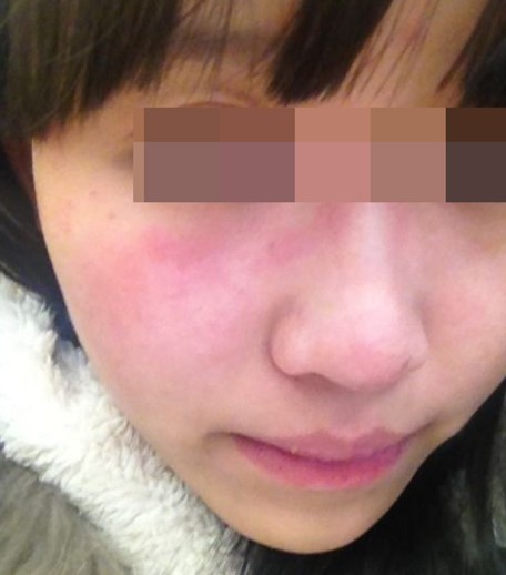 皮肤过敏的症状,从此不当小小鸟,美人鱼的华丽