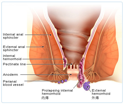 混合痔的两大危害后果