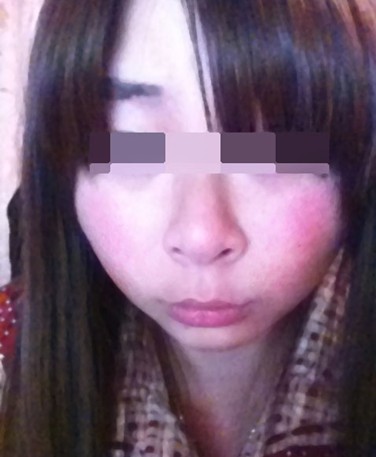 脸上过敏痒怎么办,瞧我咸鱼也能翻身化身浓桃