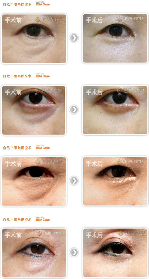 眼下皱纹_去眼下皱纹_如何去除眼下皱纹 | 流量