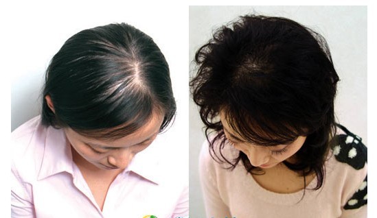 油脂性<em>脱发严重怎么办</em> 让别人也羡慕自己 - 仕