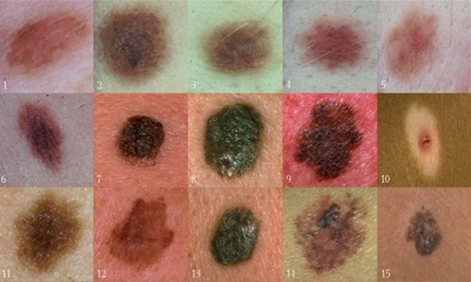 黑色素瘤早期症状(图片)及治疗_旺仔烤馒头