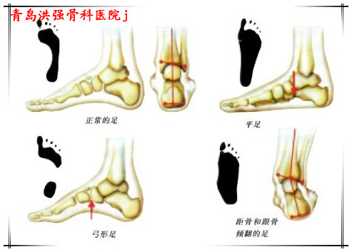 什么是扁平足,扁平足什么样子,宝宝什么是扁平足