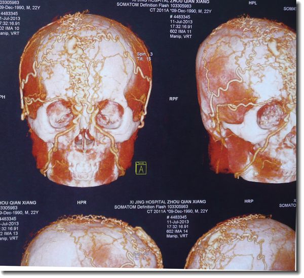 贺教授讲血管瘤:奇异的头皮血管瘤!