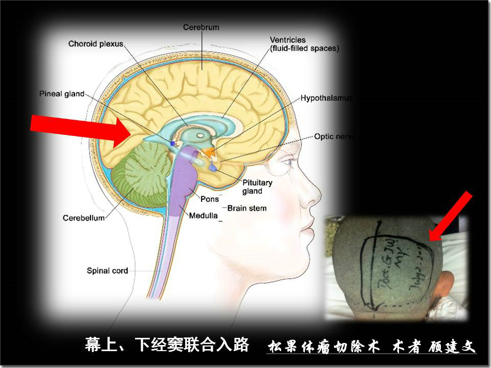 松果体及松果体瘤