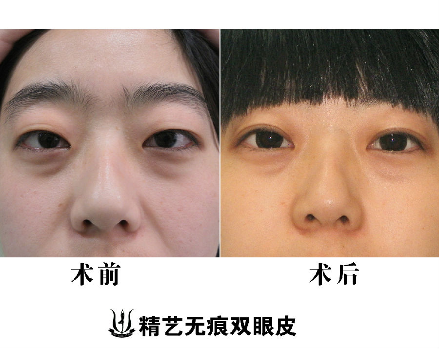 刘风卓:不是所有人都可以随便割双眼皮