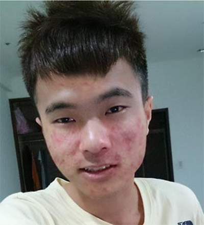 由于不良的生活习惯以及长期的工作压力,痘痘问题同样困扰着不少男士.